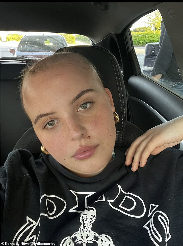 Lydia Morley (pictured) was diagnosed with alopecia areata in January this year