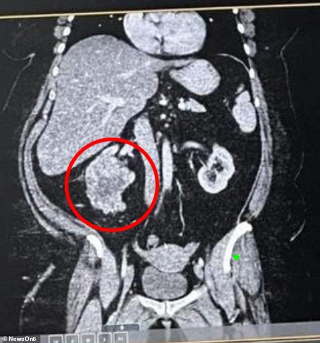 The above image of her CT scan shows the cancer as the large lump under the liver (the large area above it). The tumor was the size of a basketball