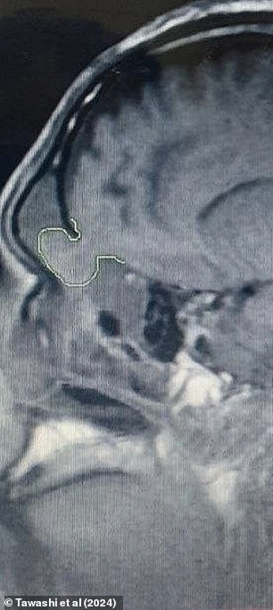 The image above shows the man's encephalocele in his nasal cavity