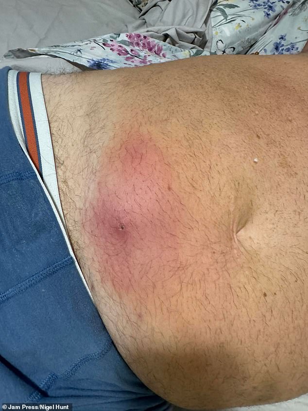 Mr Hunt, a glazier, became seriously ill a few days after his holiday when the spider bite started to get bigger