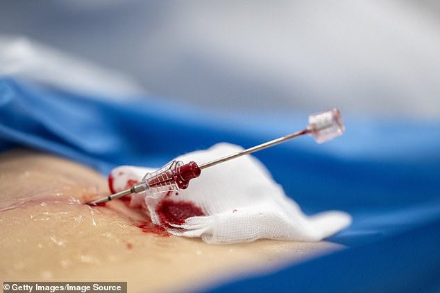 Researchers at the University of the Western Cape in South Africa developed a mixture of the two that, in laboratory tests, helped severe wounds heal almost completely in just 72 hours (file image)