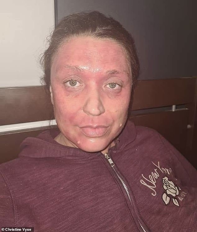 Christine Vyse told how she ended up with extremely painful, rough skin after ditching her eczema creams for the first time in 35 years