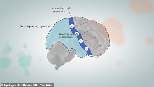 Before some people feel a migraine, their vision is disrupted. This happens when a wave of signals shoots through the brain, as in the diagram shown. These signals carry a fluid carrying proteins that cause migraines out of the brain and to pain receptors