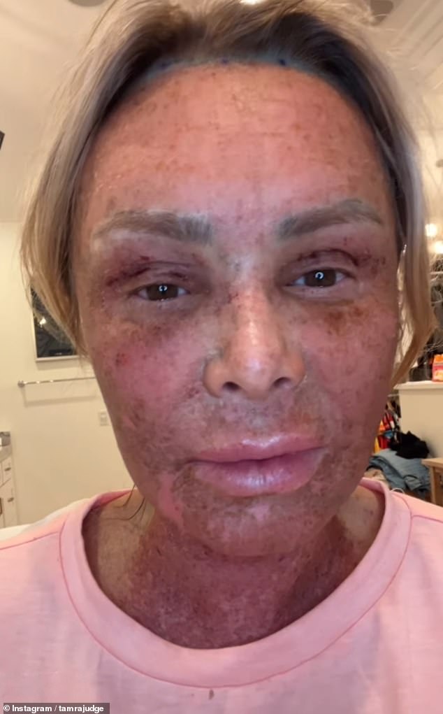 Celebrities like Real Housewives of Orange County star Tamra Judge (pictured) are turning to extreme laser treatments to achieve more youthful skin