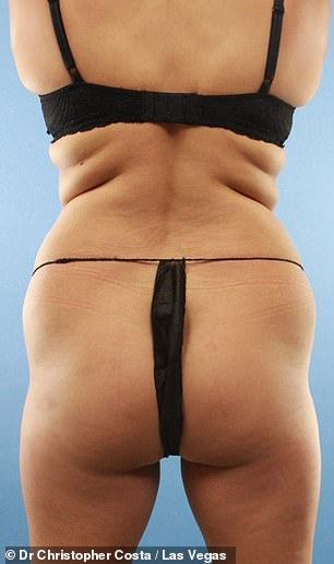 This patient had used a popular diet drug to lose weight and her buttocks had shrunk