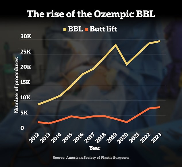 BBLs hit record high in 2023 as buttock augmentations also appear to be on the rise