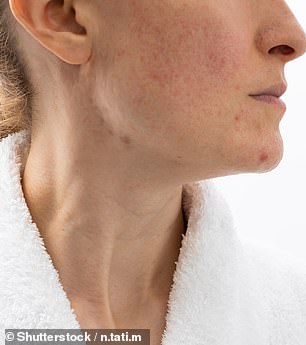 Acne on the chin and neck can be caused by menopause