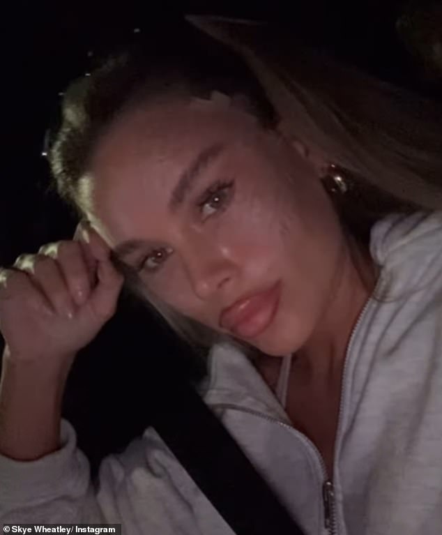 Skye Wheatley has shown off the results of her controversial fox eye lift surgery on social media after removing her post-op bandages in favor of a lighter tape (pictured)