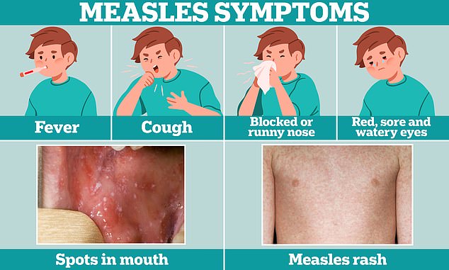 Cold-like symptoms, such as fever, cough, and a runny or stuffy nose, are usually the first sign of measles. A few days later, some people develop small white spots on the inside of their cheeks and the backs of their lips. The characteristic measles rash also develops, usually starting on the face and behind the ears before spreading to the rest of the body