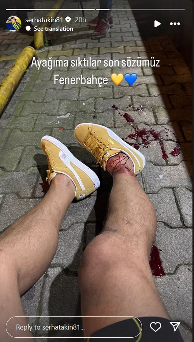 Serhat Akin confirmed he was shot after working as an expert last night, posting this graphic photo of blood coming from his right foot, with a trail of blood on the floor next to him