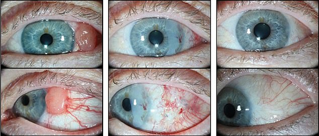 Unlike the 81-year-old woman, her entire eye did not need to be removed, as laboratory tests revealed the growth was in fact cancerous. These images show the difference before surgery (left), after surgery (center), and six months later (right).