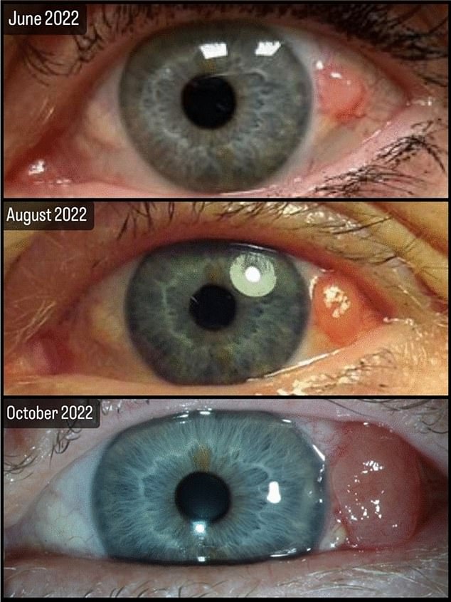 Swedish doctors have also described another horrifying case of the disease, this time in a 50-year-old woman. These images show the dramatic growth of the lesion that turned out to be cancer