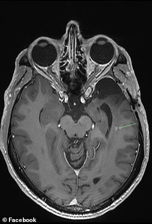 “The latest MRI brain scan is reassuringly stable, but has brought a small new focus on improvement,” said Prof. Scolyer