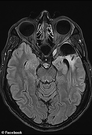 “My cerebral artery aneurysm (sac-like bulge) remains stable, so all is well on that front,” he wrote