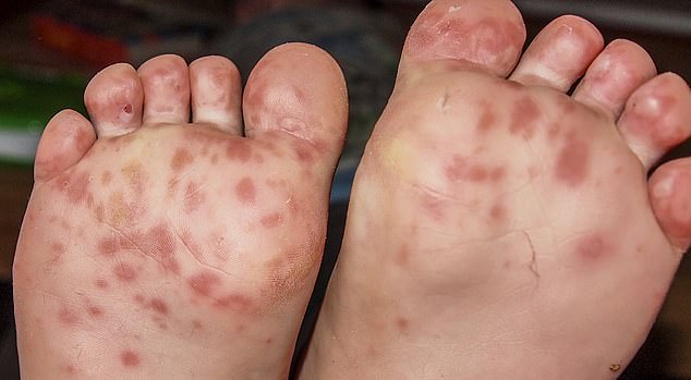 Hand, foot and mouth disease causes rashes and painful sores on the hands, feet and in the mouth. Sores may also appear on the buttocks, and although the rash is not itchy, it can be very painful