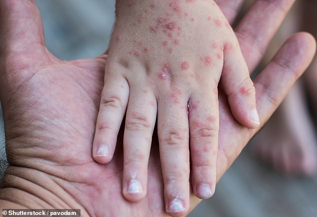 Hand, foot and mouth disease is most common in children under the age of seven. The virus has no cure and is usually gone within about a week