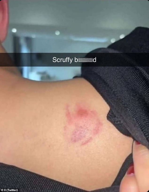 Beck shared a photo of a bite mark just below his neck and captioned it: 'Scruffy b*******'