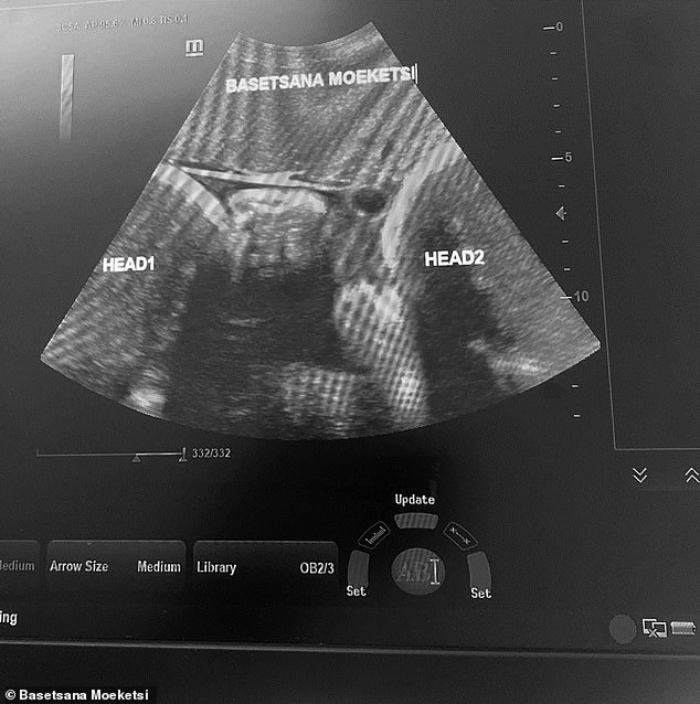 The 36-week scan (pictured) shows two babies for the first time – just a week before Basetsana gave birth