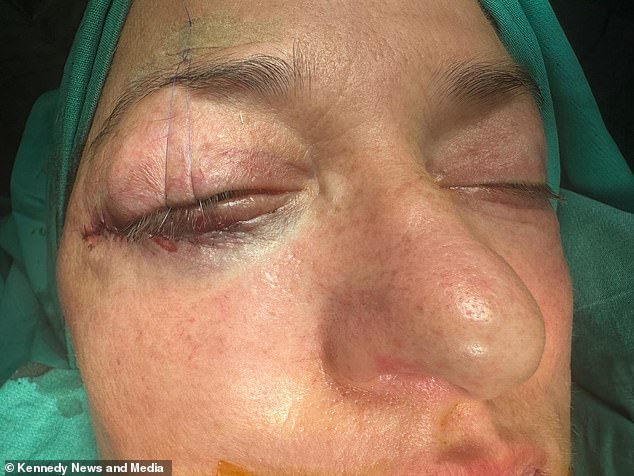 Bar manager was forced to return to Turkey for revision surgery, but claims lower eyelids fell again within a few days