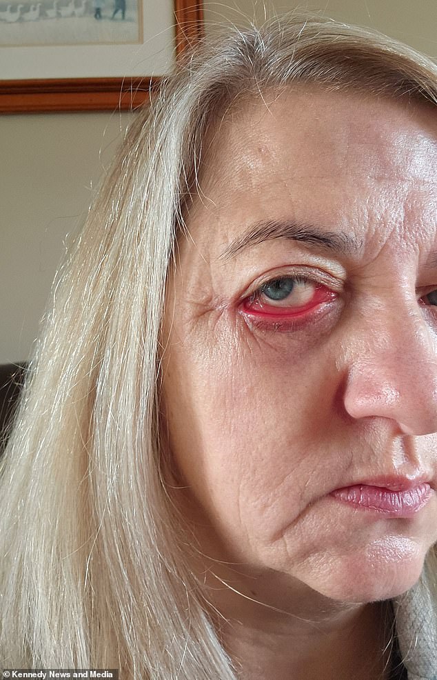 The 51-year-old said she had a loss of self-esteem as the surgery left her with drooping eyelids like a basset hound