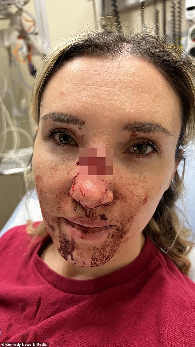 Korinne, pictured, suffered a serious injury after her dog Niko fell on her face, breaking her nose and removing a piece of skin