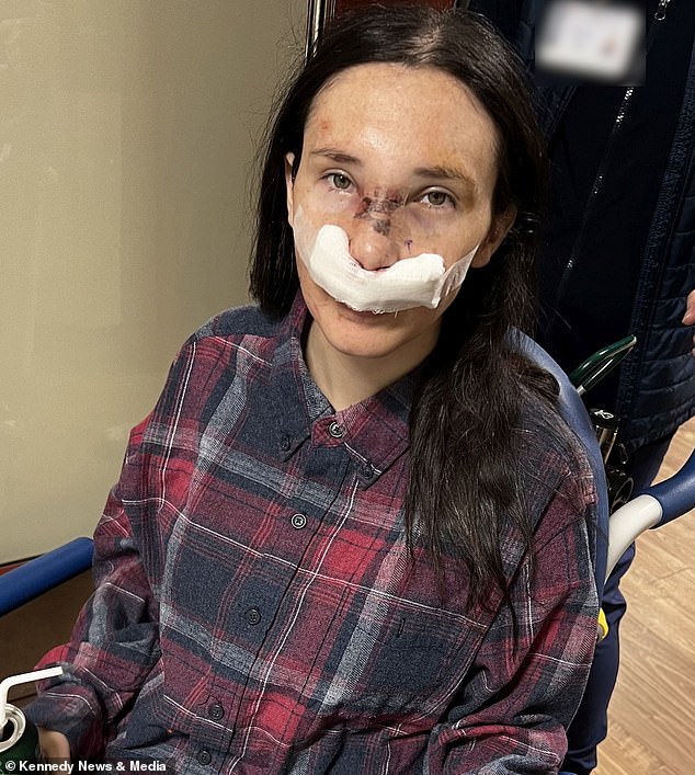 Since having surgery to repair her nose, Ms Mortensen has had two fillings to restore the shape of her nose