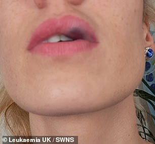 A filler injection last April immediately caused her lip to swell, causing severe bruising. Unusual bruising, unusual bleeding, fatigue, and repeated infections are all telltale signs of cancer