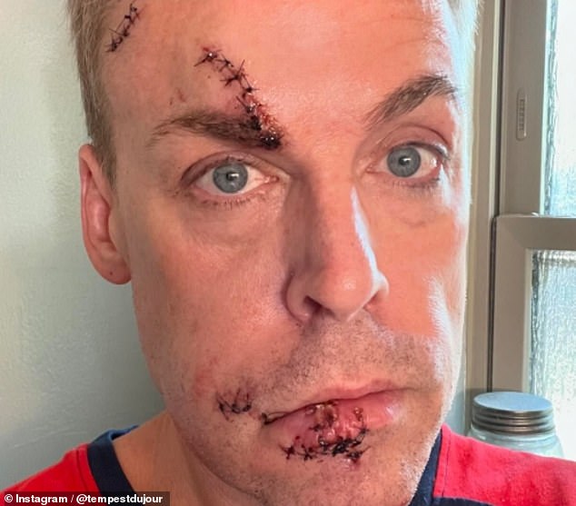 The 57-year-old told her 163,000 Instagram followers: 'Around 3am on Sunday morning I got out of bed and passed out, hitting the corner of my dresser. Five hours later I had stitches and my lower lip reattached. Ugh'