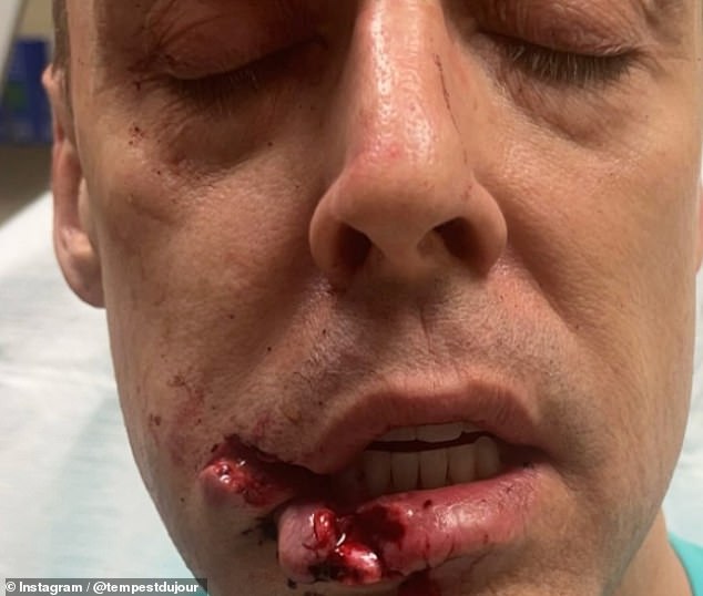 Shock photos shared on the social media platform also show the season 7 contestant's bleeding cut lip and stitches