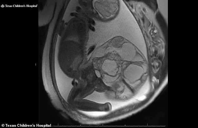 The above image shows Adalida's ultrasound scan, where the tumor – called sacrococcygeal teratoma – can be seen