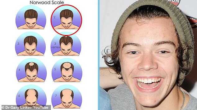 In 2012, at the age of 18, Harry's hairline began to recede slightly, placing him at stage 2 on the Norwood scale