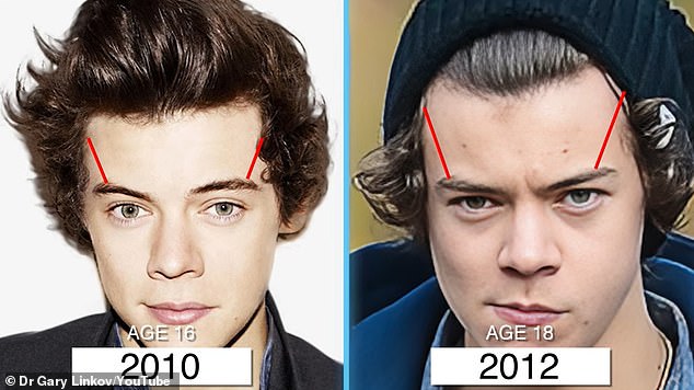 Compared to just two years earlier, in 2012, Harry's hairline receded from his eyebrows