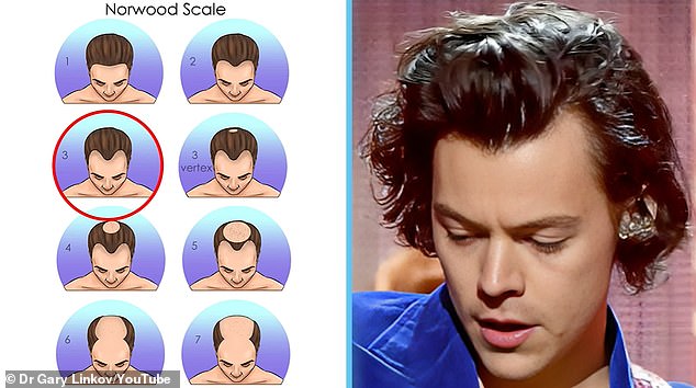 In 2019, Dr. Linkov said that Harry's hairline recession had progressed to stage 3 on the Norwood hair loss scale