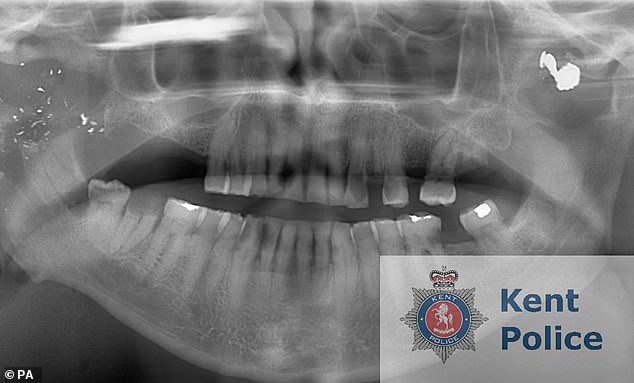 The father-of-seven, who has terminal brain cancer, still has the bullet scar and second-degree burns that remind him of the incidents. Pictured: An X-ray of Raymond Weatherall's jaw, with a bullet visible