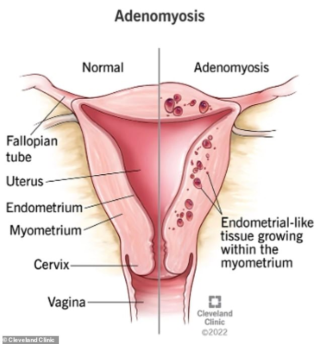 It is not known exactly why adenomyosis occurs. But the NHS notes that it is 'likely' that women with adenomyosis 'have a predisposition due to their genes, immune system and hormones'