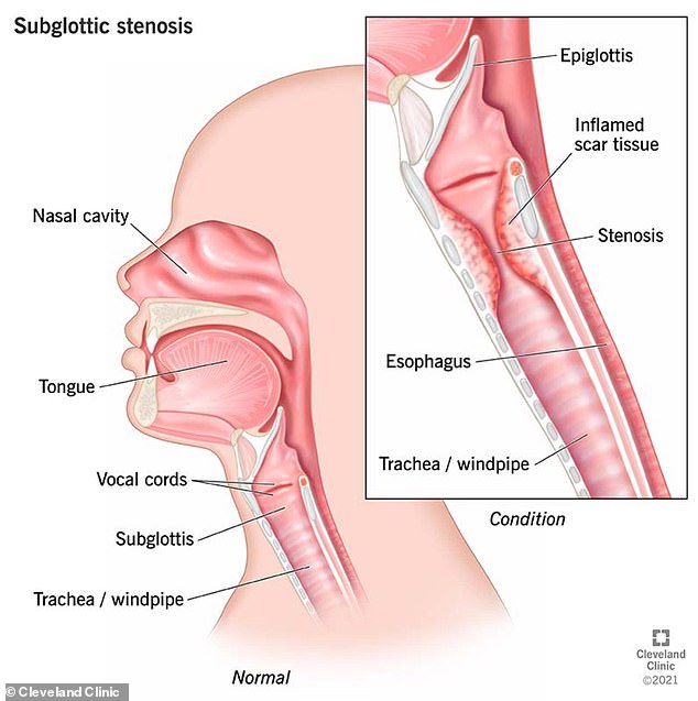 The above image from the Cleveland Clinic shows a normal airway (head) and then one with subglottic stenosis (inset)