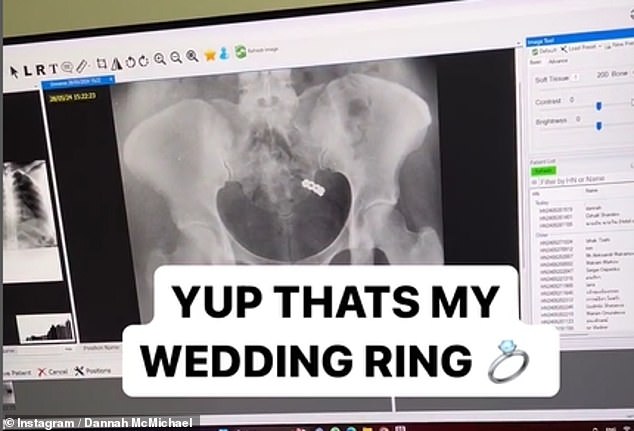 McMichael shared a video of the moment doctors found her ring, with the humorous caption: “I got my ring back. Wait, I never lost it. It was always with me'