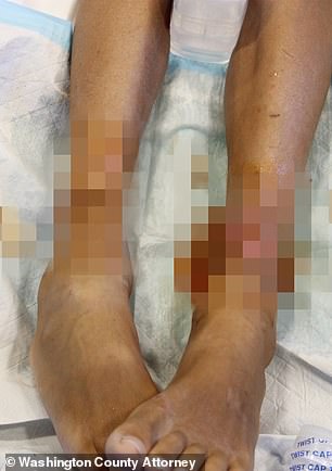 One child seen with infected cuts on his legs