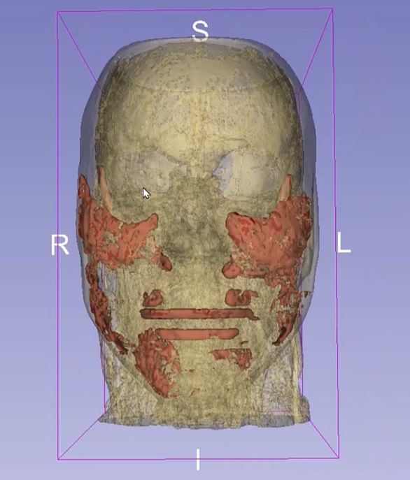 An MRI of journalist Alice Hart-Davis' face showed that 35 ml of filler remained