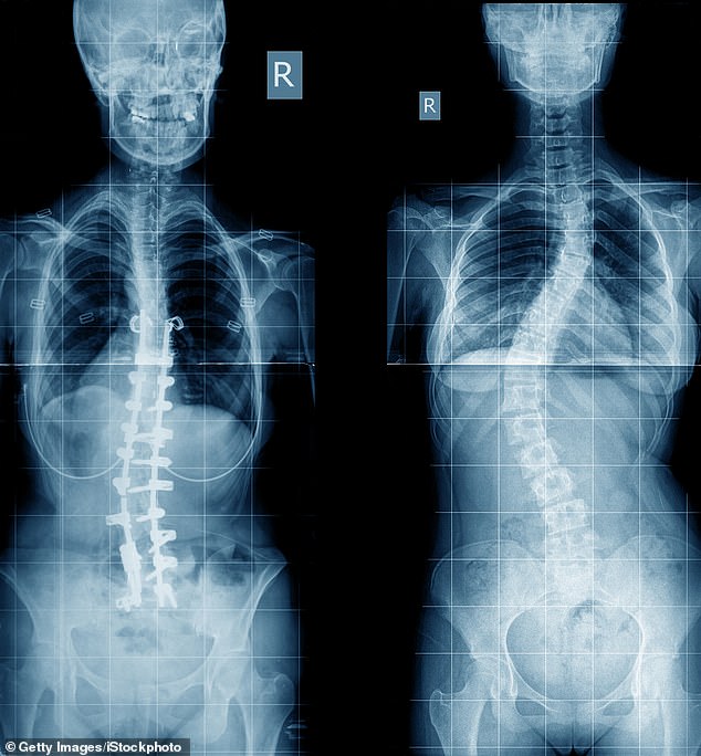 About 24 percent of people aged 16 to 26 have called in sick with back and neck pain in the past twelve months (the file shows scoliosis in the patient, right)