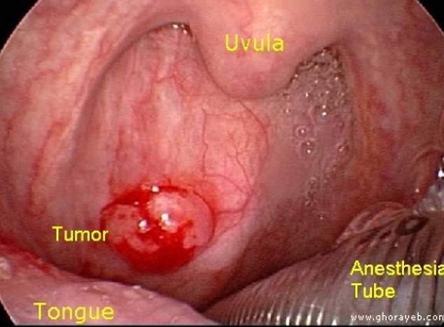 HPV causes oropharyngeal cancers in approximately 60 percent. Photo courtesy of medbullets.com