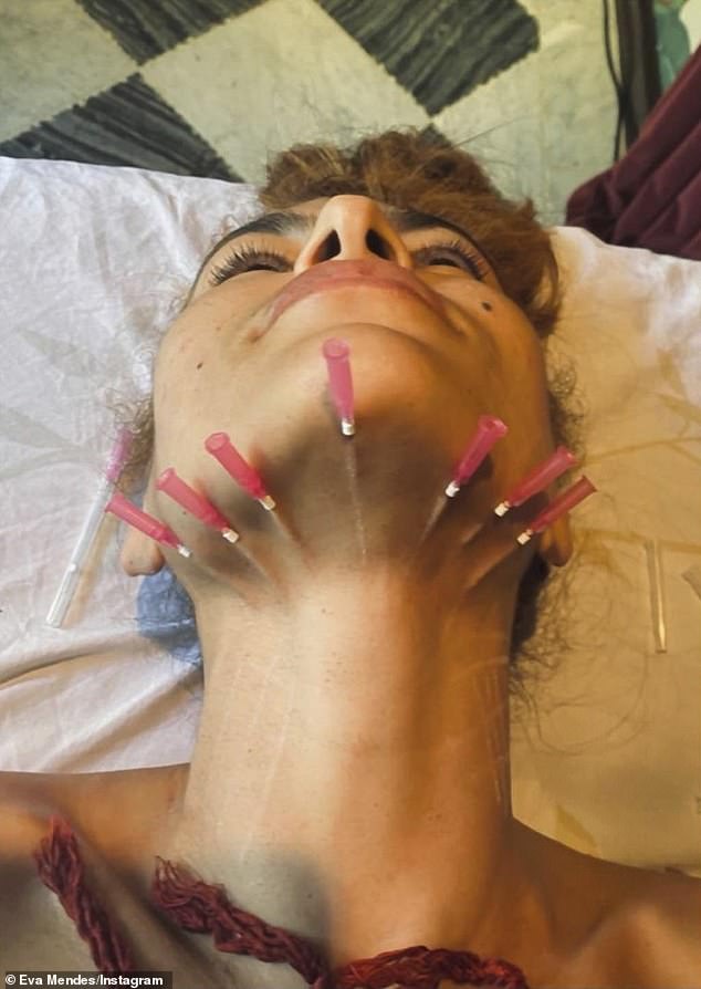 In 2020, she shared photos of herself undergoing a procedure called Mono-threading, which involves the insertion of needle threads at various points to facilitate lifting and tightening of the skin