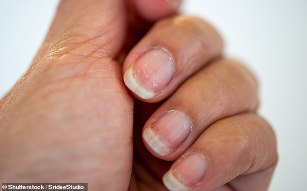 Brittle nails can be a sign of iron and protein deficiency, Dr. Sethi said in his TikTok video