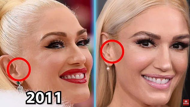 He also shared these photos of Gwen to suggest she may have had a facelift. The surgery involves making and tightening incisions around the ears, which can cause changes in the appearance of the earlobe and the tragus, the tongue-like protrusion on the outer ear (circled)