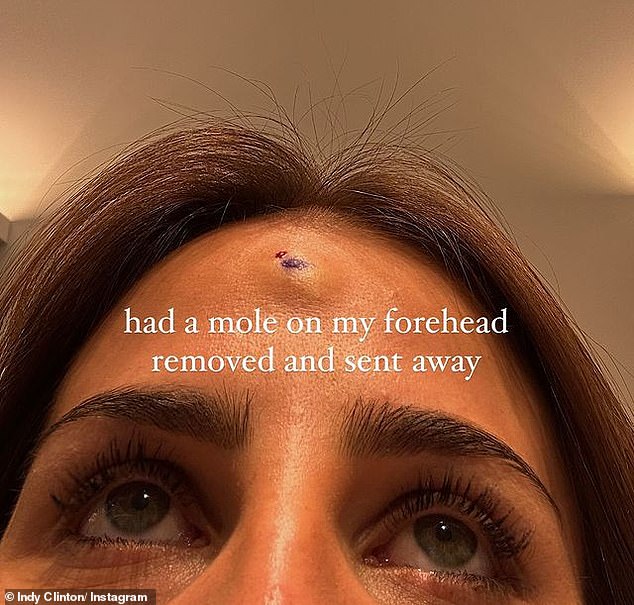 The TikTok superstar, 27, took to Instagram on Tuesday to share a graphic image of her forehead after having a mole removed