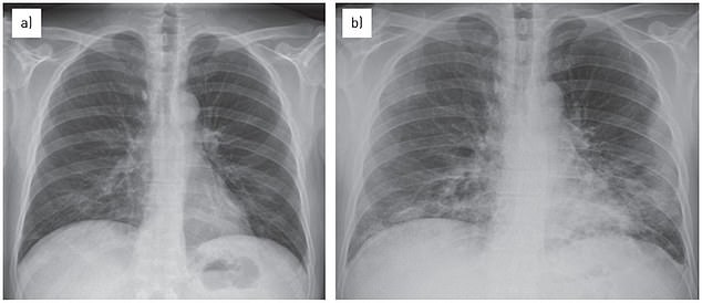 The white masses in the lungs represent fluid-filled air sacs that infectious disease experts say indicate mycoplasma pneumonia