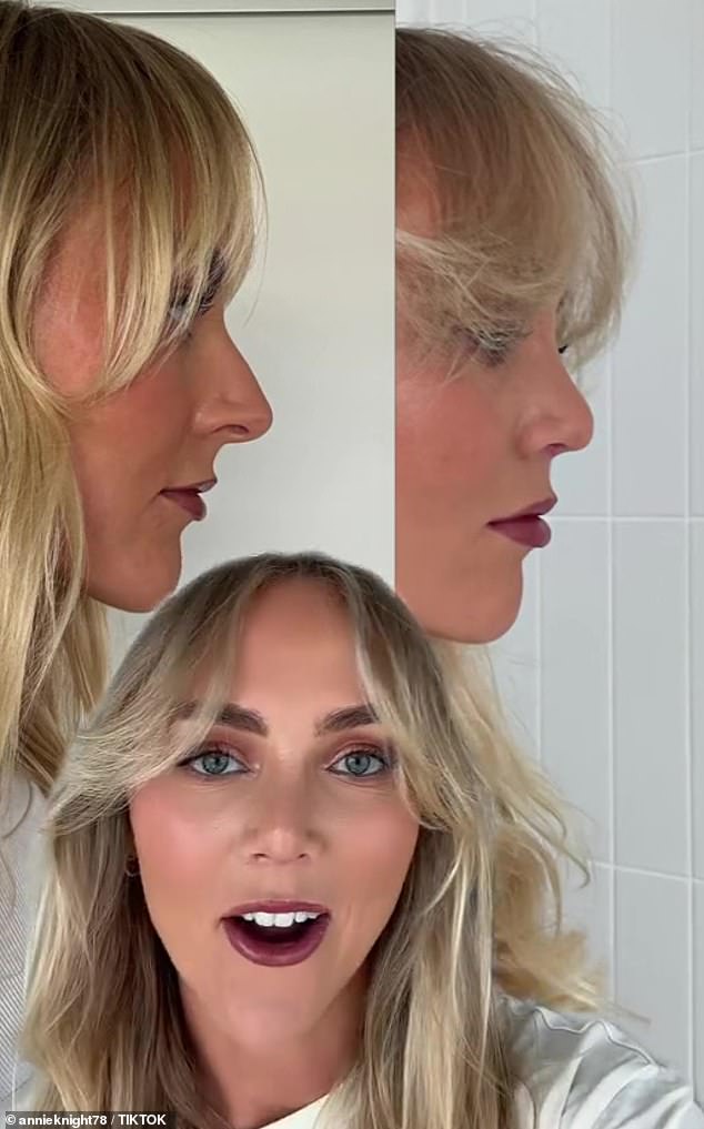 Annie recently shared a video on TikTok with before and after photos of her nose after undergoing the cosmetic procedure