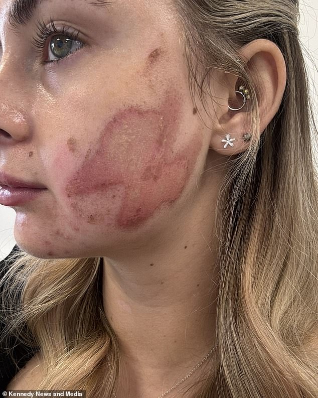 Ms Nielsen claims doctors confirmed it was a chemical burn and she was given a water-based cream to treat the burn and told to apply it every hour for ten days.