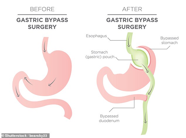 Bariatric surgery, commonly known as weight loss surgery, consists of a variety of possible procedures, including gastric sleeves, gastric bypass, and gastric banding. This illustrated example shows a gastric bypass