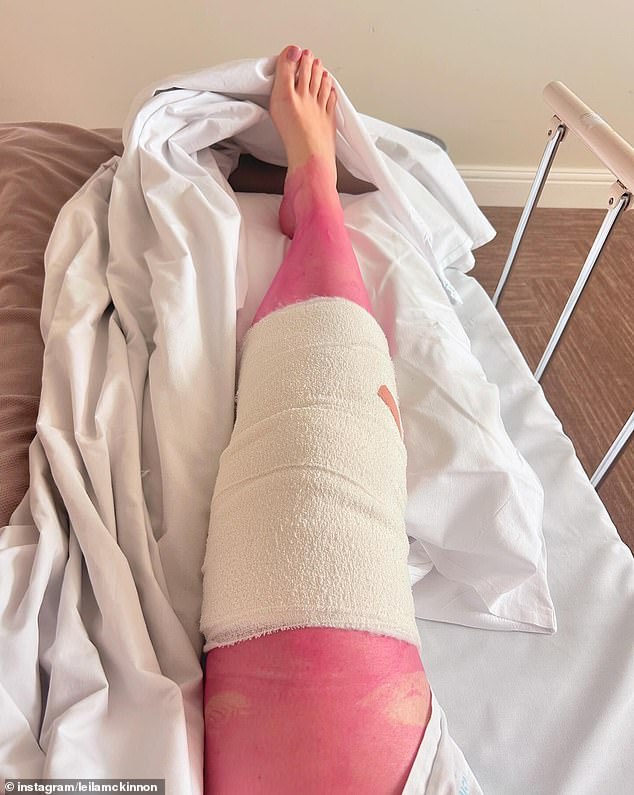 Leila shared an image of her leg, which was a vibrant pink color. 'I may or may not be as high as a kite after another wonderful knee operation. But something alarming seems to have happened... is my leg pink? By the way, the surgical team played me some brilliant Chappell Roan tunes,” she wrote in the caption